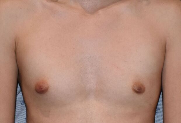 Breast Augmentation: Case 35 - Before