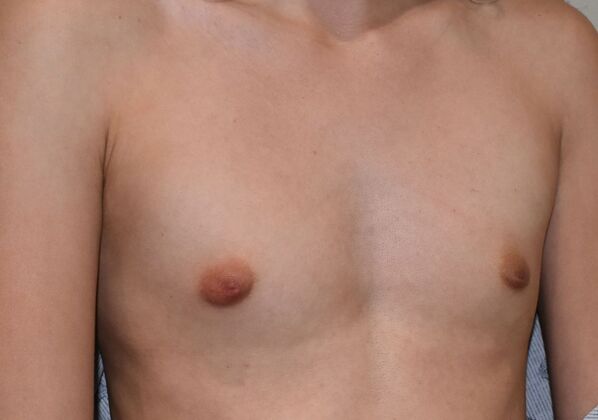 Breast Augmentation: Case 35 - Before