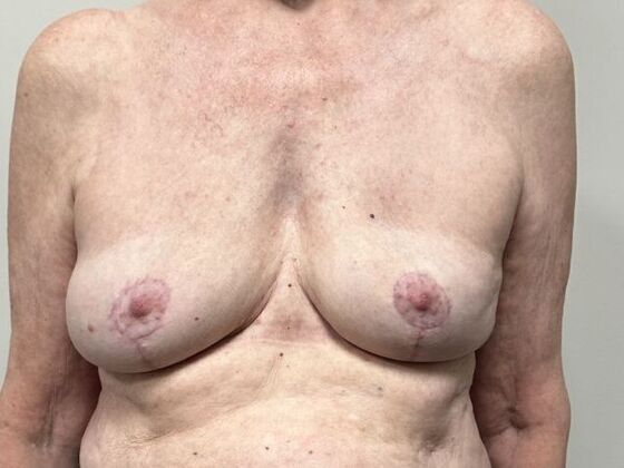 Breast Implant Removal Case 70 - After