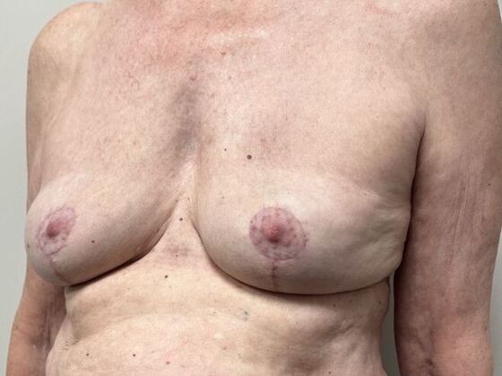 Breast Implant Removal: Case 70 - After