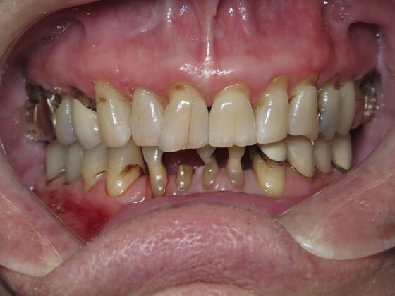 Bridges Case 3 - Before