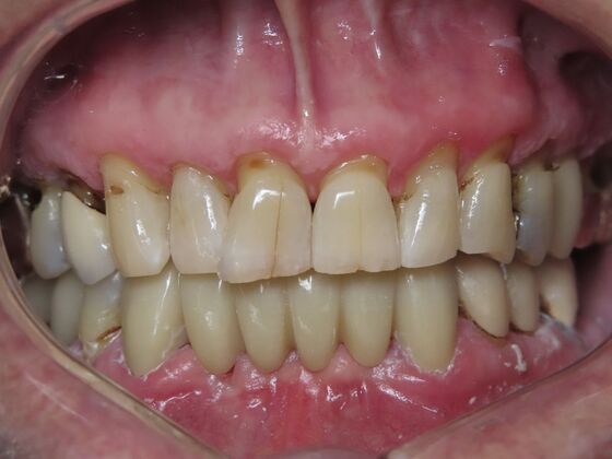 Bridges Case 3 - After