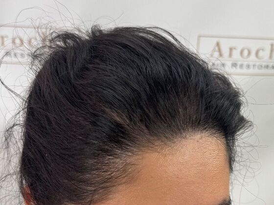 FUT Female: Case 10 - After