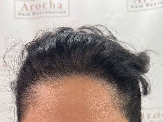 FUT Female: Case 10 - After
