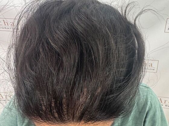 FUT Female: Case 10 - After