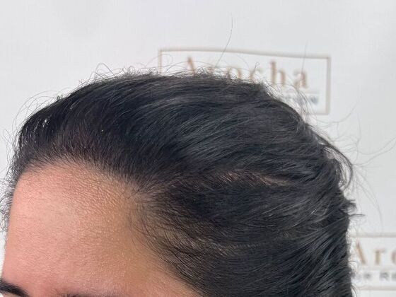 FUT Female: Case 10 - After