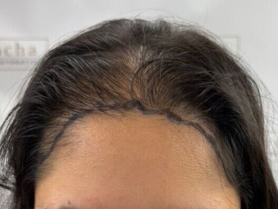 FUT Female: Case 10 - Before