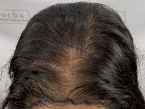FUT Female: Case 10 - Before