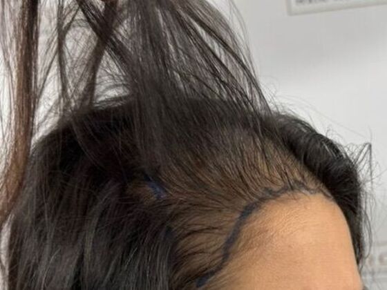 FUT Female: Case 10 - Before