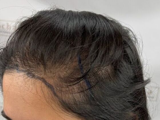 FUT Female: Case 10 - Before