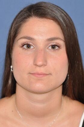 Rhinoplasty: Rhinoplasty for tip hanging down - Before