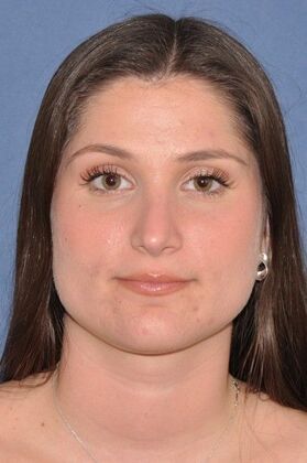 Rhinoplasty: Rhinoplasty for tip hanging down - After