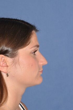 Rhinoplasty: Rhinoplasty for tip hanging down - Before