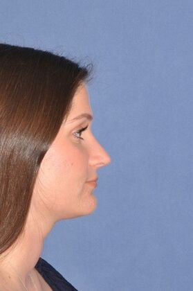 Rhinoplasty: Rhinoplasty for tip hanging down - After