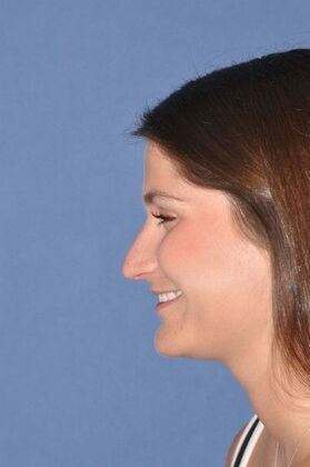 Rhinoplasty: Rhinoplasty for tip hanging down - Before
