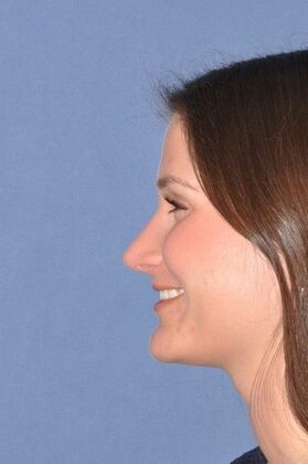 Rhinoplasty: Rhinoplasty for tip hanging down - After