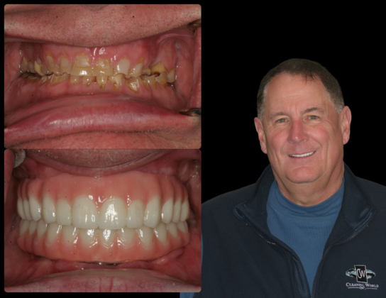 All-on-4 Dental Implants Case 6: Ridgewood, NJ