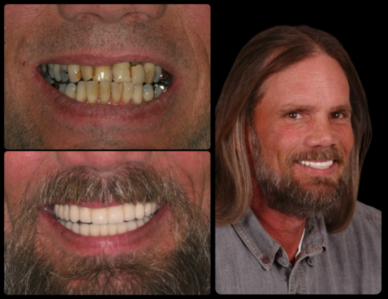 Full Mouth Reconstruction Case 9