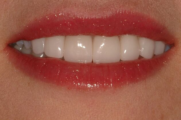 Full Mouth Reconstruction Case 9 - After