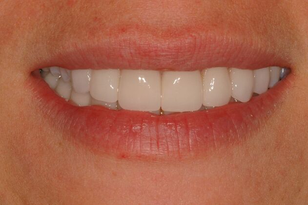 Full Mouth Reconstruction: Case 9 - After