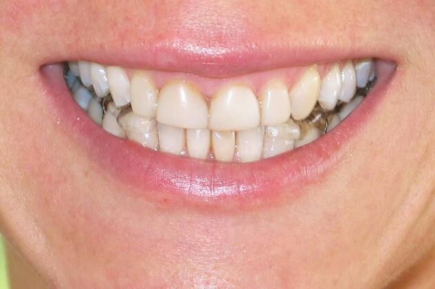 Full Mouth Reconstruction Case 9 - Before