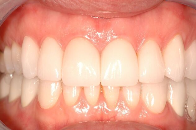 Full Mouth Reconstruction: Case 9 - After - Retracted