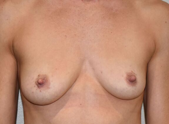 Breast Augmentation w/ Lift: Case 656 - Before
