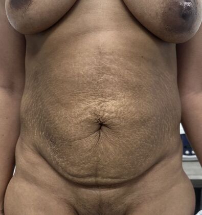 Tummy Tuck (Abdominoplasty): Case 597 - Before