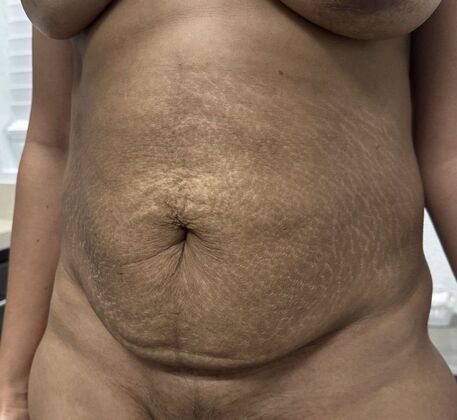 Tummy Tuck (Abdominoplasty): Case 597 - Before
