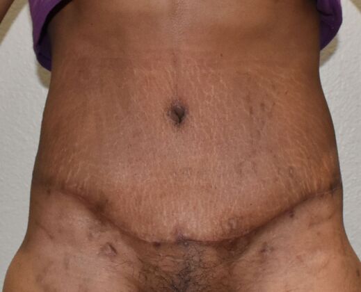 Tummy Tuck (Abdominoplasty): Case 597 - After
