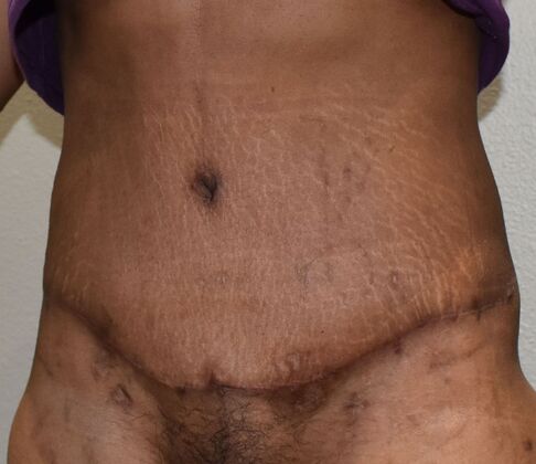 Tummy Tuck (Abdominoplasty): Case 597 - After