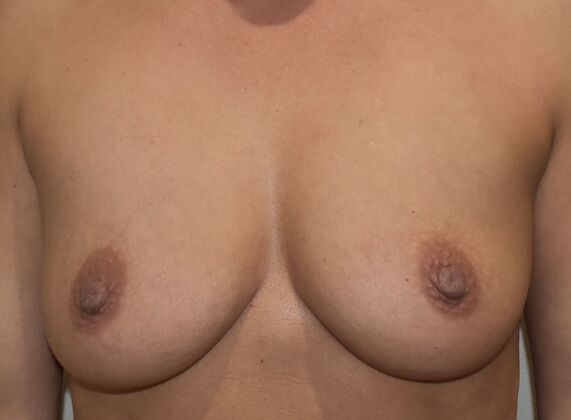 Breast Augmentation: Case 4 - Before