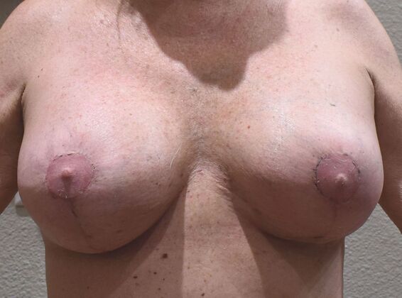 Breast Revision Case 346 - After