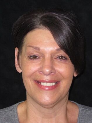 Full Mouth Implants: Same-Day Teeth, Zirconia Bridge, and Feeling Like Herself Again - Before