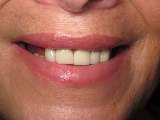 Full Mouth Implants: Same-Day Teeth, Zirconia Bridge, and Feeling Like Herself Again - Before