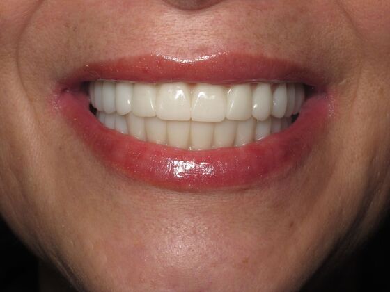 Full Mouth Implants: Same-Day Teeth, Zirconia Bridge, and Feeling Like Herself Again - After
