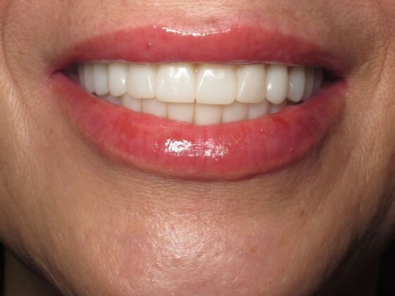 Full Mouth Implants: Same-Day Teeth, Zirconia Bridge, and Feeling Like Herself Again - After