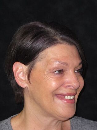 Full Mouth Implants: Same-Day Teeth, Zirconia Bridge, and Feeling Like Herself Again - Before