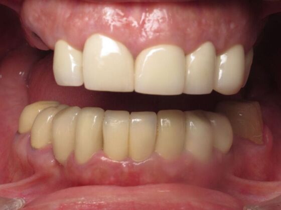 Full Mouth Implants: Same-Day Teeth, Zirconia Bridge, and Feeling Like Herself Again - Before