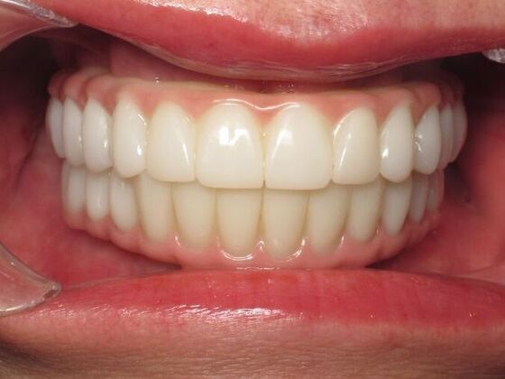 Full Mouth Implants: Same-Day Teeth, Zirconia Bridge, and Feeling Like Herself Again - After