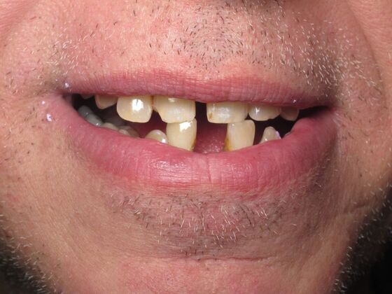 Teeth in a Day: Immediate Upper and Lower Implants for Severe Gum Disease and Bone Loss - Before