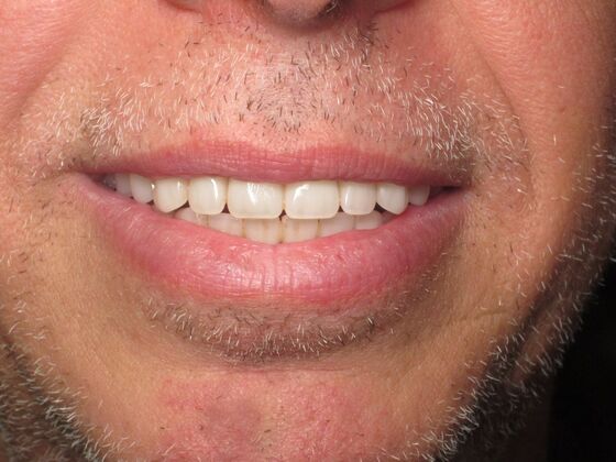 Teeth in a Day: Immediate Upper and Lower Implants for Severe Gum Disease and Bone Loss - After