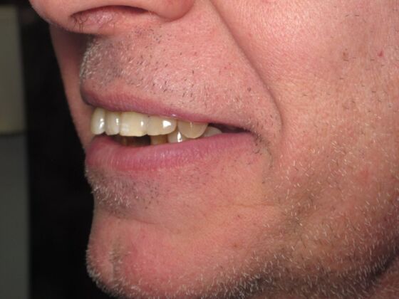 Teeth in a Day: Immediate Upper and Lower Implants for Severe Gum Disease and Bone Loss - Before