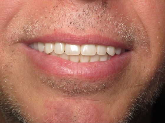 Teeth in a Day: Immediate Upper and Lower Implants for Severe Gum Disease and Bone Loss - After
