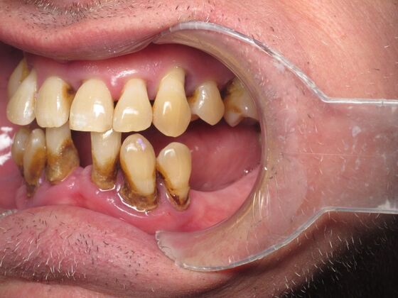 Teeth in a Day: Immediate Upper and Lower Implants for Severe Gum Disease and Bone Loss - Before