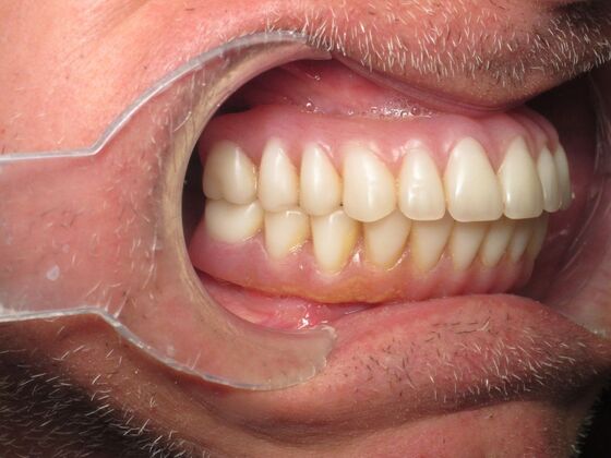 Teeth in a Day: Immediate Upper and Lower Implants for Severe Gum Disease and Bone Loss - After