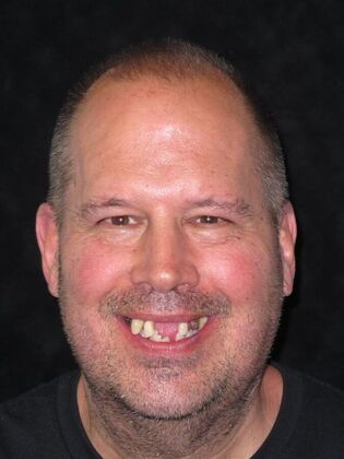 Full Mouth Implants: Immediate Upper and Lower Implants After Tooth Loss, Bone Loss, and Staining - Before