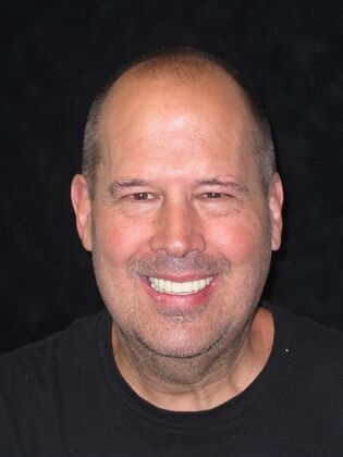 Full Mouth Implants: Immediate Upper and Lower Implants After Tooth Loss, Bone Loss, and Staining - After