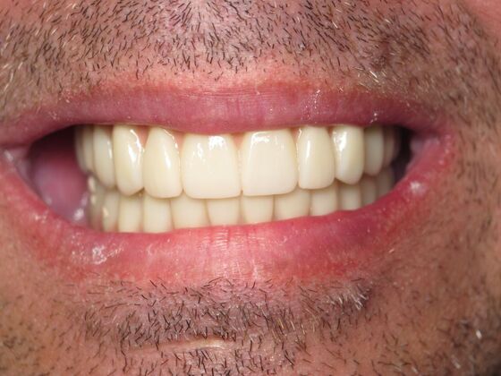 Full Mouth Implants: Immediate Upper and Lower Implants After Tooth Loss, Bone Loss, and Staining - After