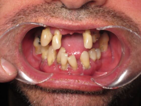 Full Mouth Implants: Immediate Upper and Lower Implants After Tooth Loss, Bone Loss, and Staining - Before